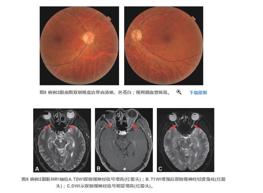 以假乱真——2例甲醇中毒性视神经病变的临床特征