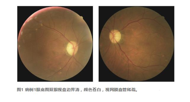 以假乱真——2例甲醇中毒性视神经病变的临床特征